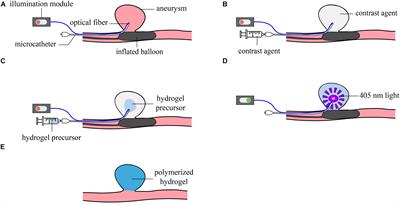 In vitro Implementation of Photopolymerizable Hydrogels as a Potential Treatment of Intracranial Aneurysms